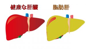 脂肪肝と健康な肝臓の比較
