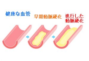 動脈硬化 血管 血液